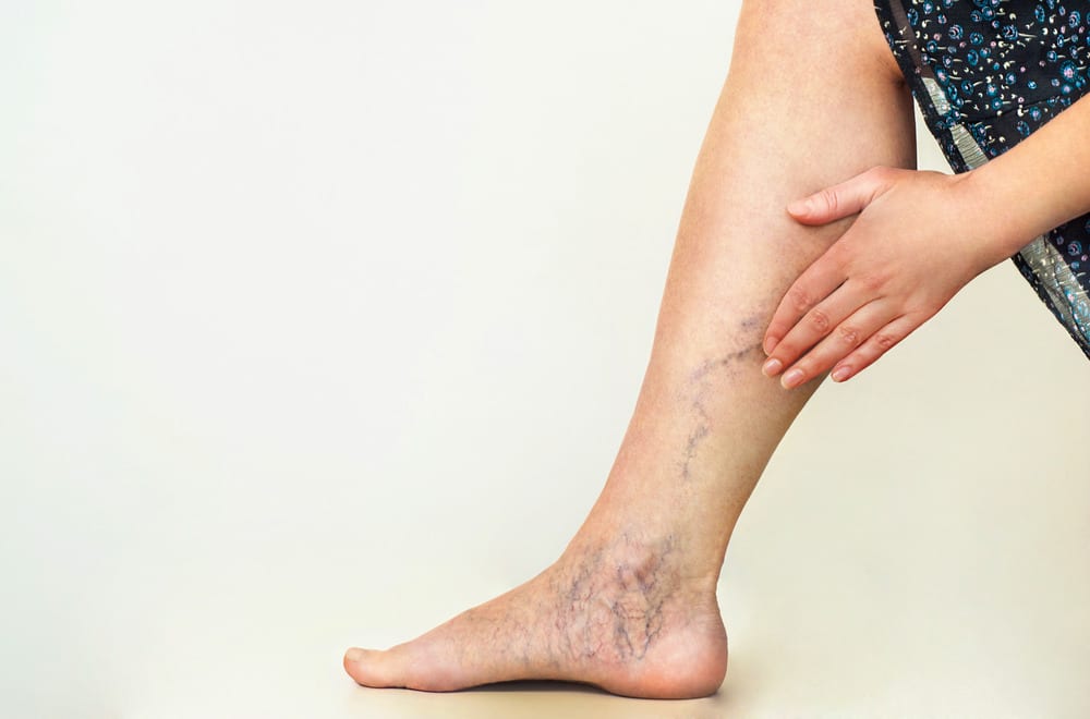 venous-disease venous disease